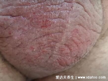 阴囊湿疹图片初期症状大全，有红斑磷屑伴随剧烈瘙痒疼痛
