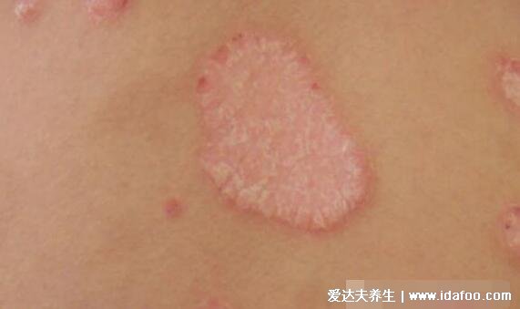 荨麻疹初期症状图片，急性有风团瘙痒还可发热(100种皮肤病对照图片)