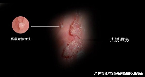 男女性尖疣湿早期症状图片，在初期出现淡红色丘疹(可呈鸡冠菜花状)