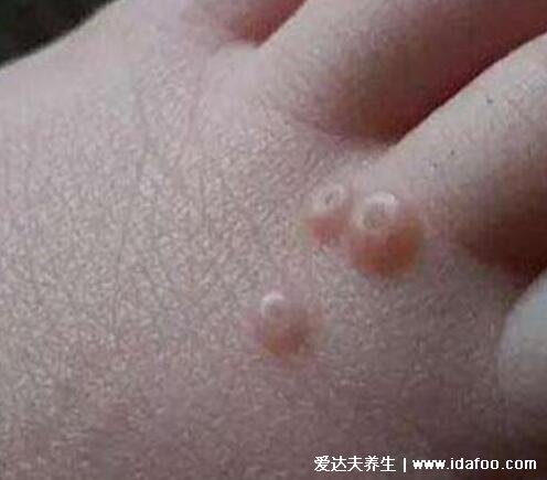 病毒性软疣的症状图片，蜡黄光泽丘疹可增大(儿童成人都可发病)