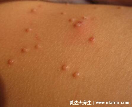 病毒性软疣的症状图片，蜡黄光泽丘疹可增大(儿童成人都可发病)