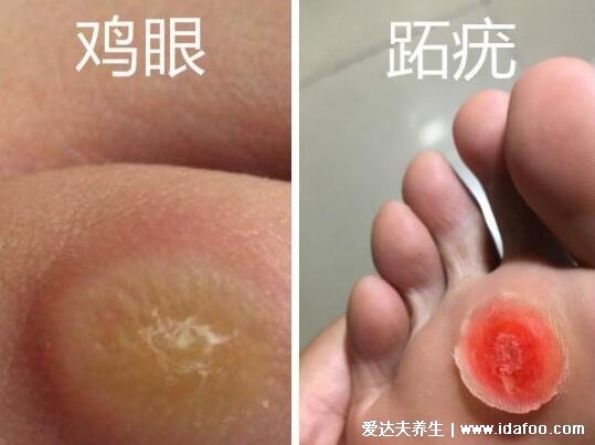 趾疣症状图片是什么样子，初期细小发亮丘疹(到后面有粗糙角质)
