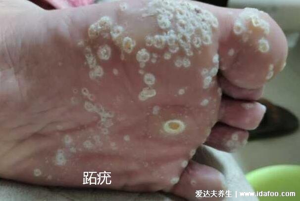趾疣症状图片是什么样子，初期细小发亮丘疹(到后面有粗糙角质)