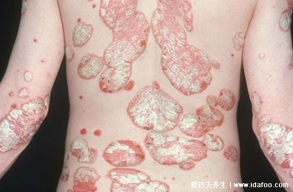 严重牛皮肤癣的症状图片是什么样子，中晚期被称为不死的癌症(4种类型)