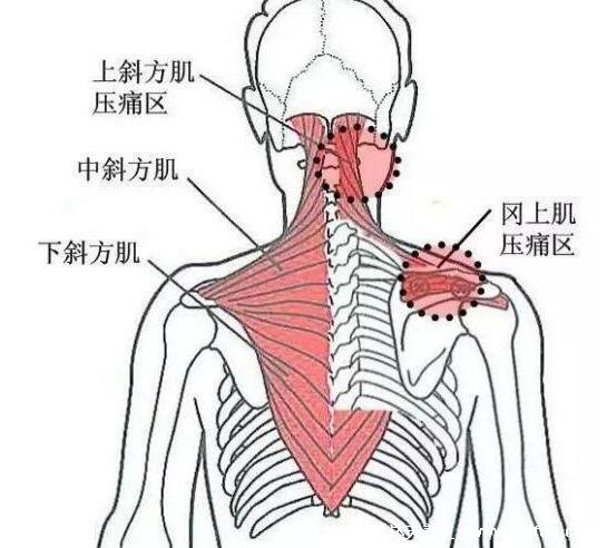 背部筋膜炎疼痛位置图，身体背部各部位疼痛对照图