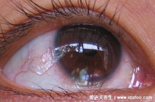 青光眼的早期症状图片自查，警惕大量喝水时会头疼眼胀