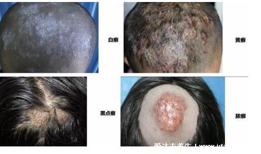 头皮癣症状图片早期图片，包括黄藓/白藓/黑藓三种类型(可多发儿童)