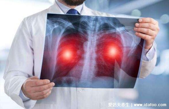 警惕肺癌的15个征兆，从早期到晚期只需几个月的时间