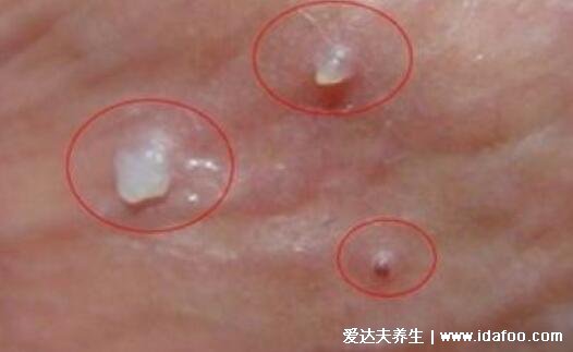 男女性疱疹图片和症状图片，初早期剧烈瘙痒后长出成片的水疱