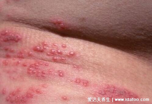 男女性疱疹图片和症状图片，初早期剧烈瘙痒后长出成片的水疱