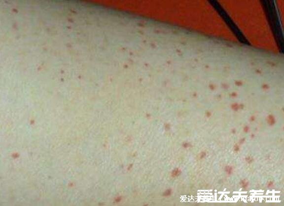 艾滋病最初皮疹图片症状图片，手脚胸背可出现深红色隆起疹子