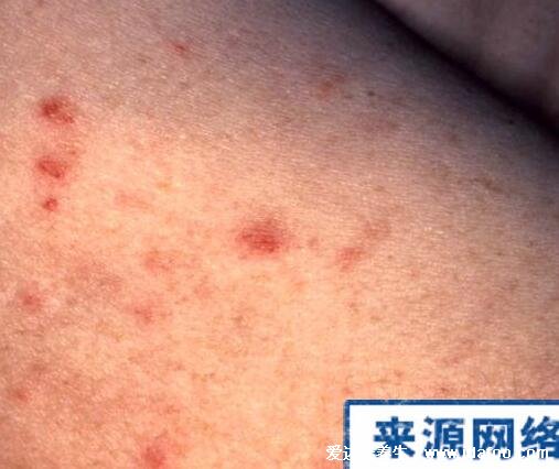 艾滋病最初皮疹图片症状图片，手脚胸背可出现深红色隆起疹子