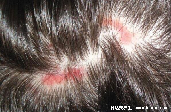 红斑狼疮早期症状图片，初期皮肤有蝴蝶型红斑伴随严重脱发