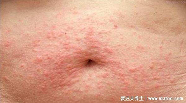 真实女性皮肤过敏图片症状，荨麻疹或过敏性皮炎都会长红疙瘩