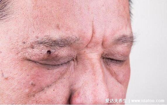 初早期面部老年斑图片高清图，老年斑的形成原因及怎么去除