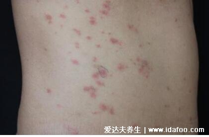 玫瑰糠疹图片初期症状，1到3厘米淡红色斑有鳞屑( 注意类似感冒症状)   