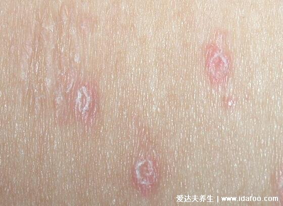 玫瑰糠疹图片初期症状，1到3厘米淡红色斑有鳞屑( 注意类似感冒症状)   
