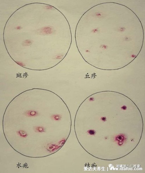 成人水痘的症状和图片初期，大人症状比儿童严重(7天演变过程图片) 