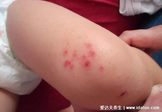 红色斑丘疹的图片是什么病，过敏性湿疹有红斑丘疹伴随剧烈瘙痒