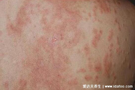 红色斑丘疹的图片是什么病，过敏性湿疹有红斑丘疹伴随剧烈瘙痒