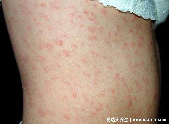 初期男女性梅毒疹图片及症状，全身多处长小红疙瘩不痛不痒会溃烂