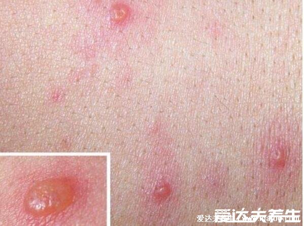 水痘刚开始的样子图片，初期会发热而且有瘙痒丘疹(大人症状更严重)