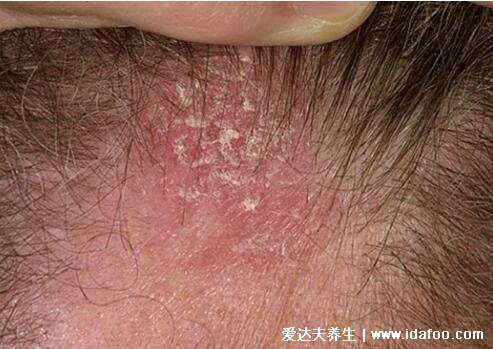 初期脂溢性皮炎图片和症状，发生在头皮会导致头皮屑和脱发