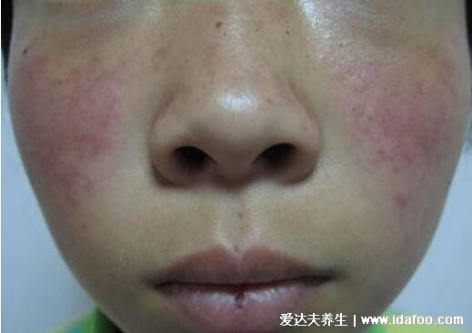 早期红斑狼疮是什么症状图片，注意不是皮肤病严重危及生命