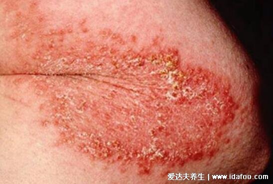 早期接触性皮炎症状图片，不同部位长红斑/丘疹/水疱(不会传染)