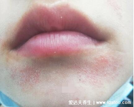 口周皮炎图片及症状，在嘴巴周围长丘疹脓疱会瘙痒灼痛