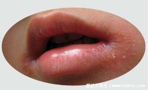 口周皮炎图片及症状，在嘴巴周围长丘疹脓疱会瘙痒灼痛