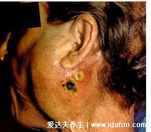腮腺炎的症状图片，流行性腮腺炎会出现高热腮部肿胀(春冬高发)