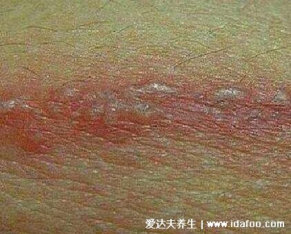 蛇胆疮图片初期症状图片，皮肤痛发热有红点可发展为水泡(神经痛)