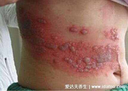 蛇胆疮图片初期症状图片，皮肤痛发热有红点可发展为水泡(神经痛)