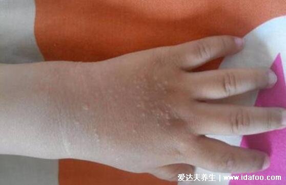手指长水泡是大病前兆图片，水疱疹/手足口病不要惊慌(附艾滋病水泡图)