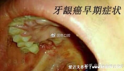 牙龈癌的早期三大症状，注意病程极长口腔溃疡/牙齿松动/张口困难