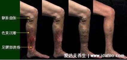 早期小腿静脉曲张图片症状，腿部疲乏无力还表浅静脉迂曲扩张