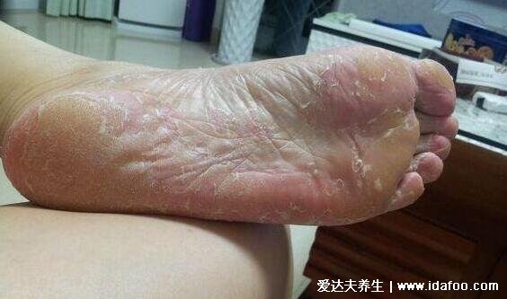 各种脚气的症状图片大全，水疱型最痒传染性最强(附根治法)