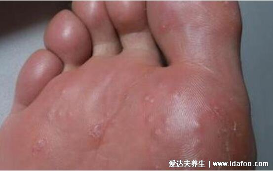 各种脚气的症状图片大全，水疱型最痒传染性最强(附根治法)