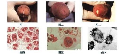 男女淋病的早期症状图片真人图，生殖器红肿有脓性分泌物