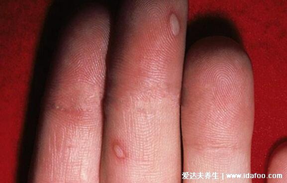 手足口病症状图片及发展过程演示图，长红色丘疹和疱疹伴随低烧
