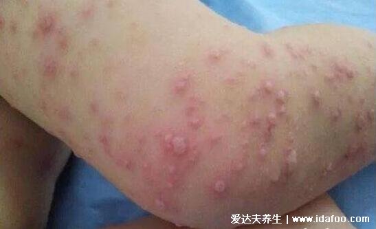 手足口病症状图片及发展过程演示图，长红色丘疹和疱疹伴随低烧
