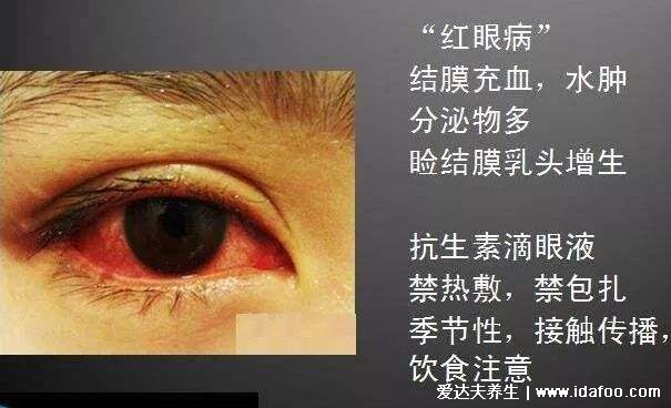初期结膜炎图片及症状，就是红眼病有很强的传染性