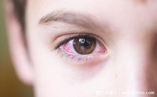初期结膜炎图片及症状，就是红眼病有很强的传染性