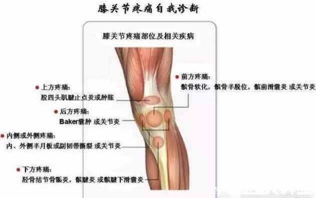 女性膝盖痛的可能问题，有三种病关节炎最常见(膝盖各个部位疼痛图解)