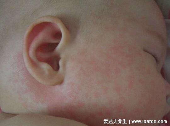 麻疹图片初期症状，红色斑疹从耳后蔓延至躯干(注意和幼儿急疹区分)