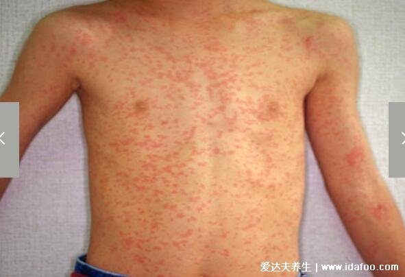 麻疹图片初期症状，红色斑疹从耳后蔓延至躯干(注意和幼儿急疹区分)