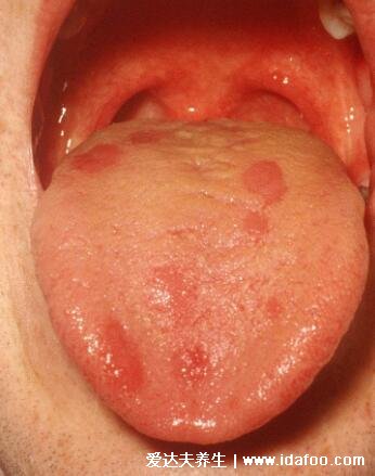 舌癌的早期症状图片，舌部疼痛吞咽困难(嚼槟榔易致舌癌)