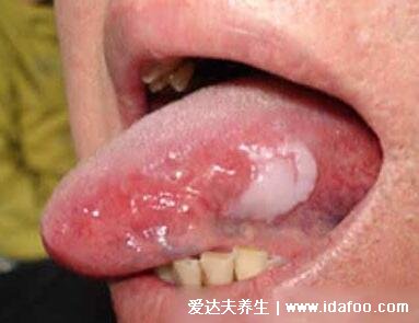 舌癌的早期症状图片，舌部疼痛吞咽困难(嚼槟榔易致舌癌)