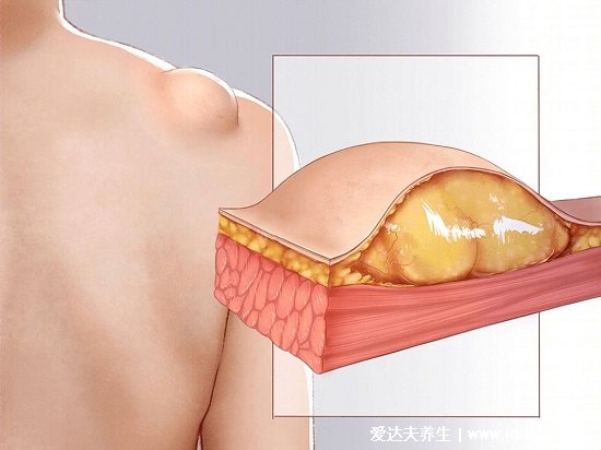 脂肪瘤图片是什么样子，背部和脖子脂肪瘤图片(40到60岁多发)